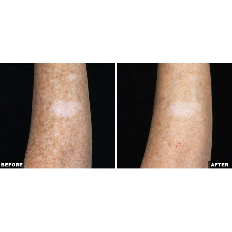 Fraxel Dual Laser Resurfacing
