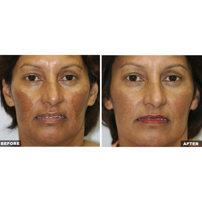 Fraxel Dual Laser Resurfacing