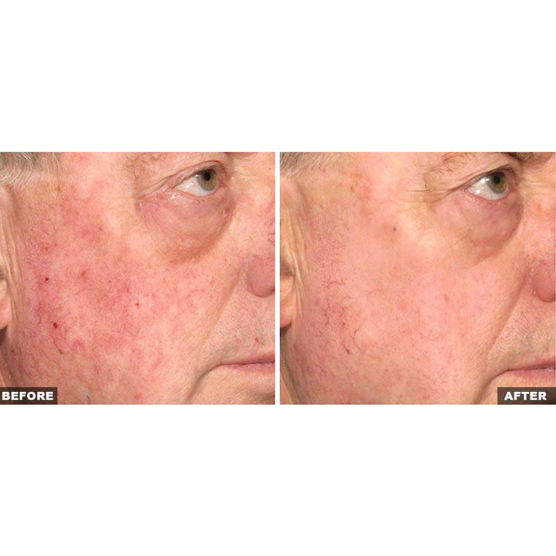 Fraxel Dual Laser Resurfacing