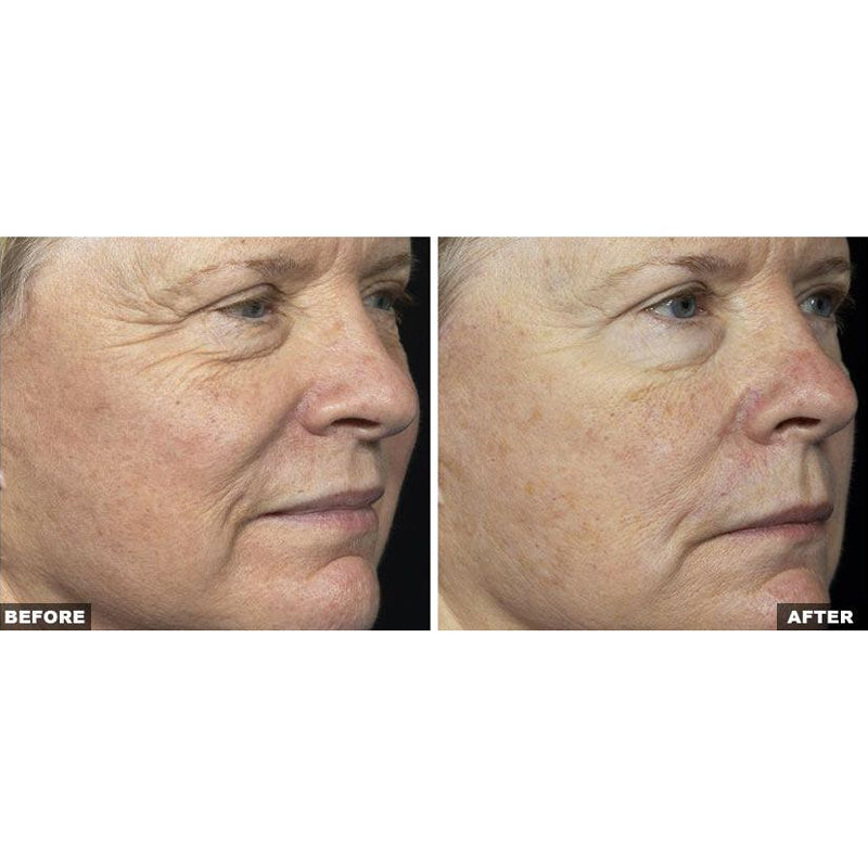 Fraxel Dual Laser Resurfacing