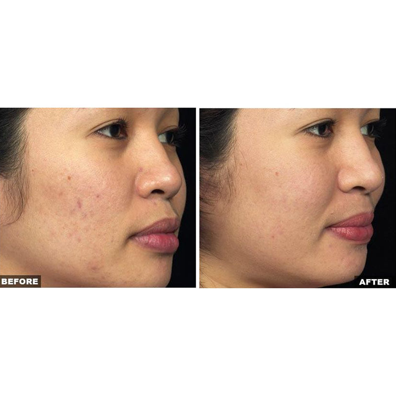 Fraxel Dual Laser Resurfacing