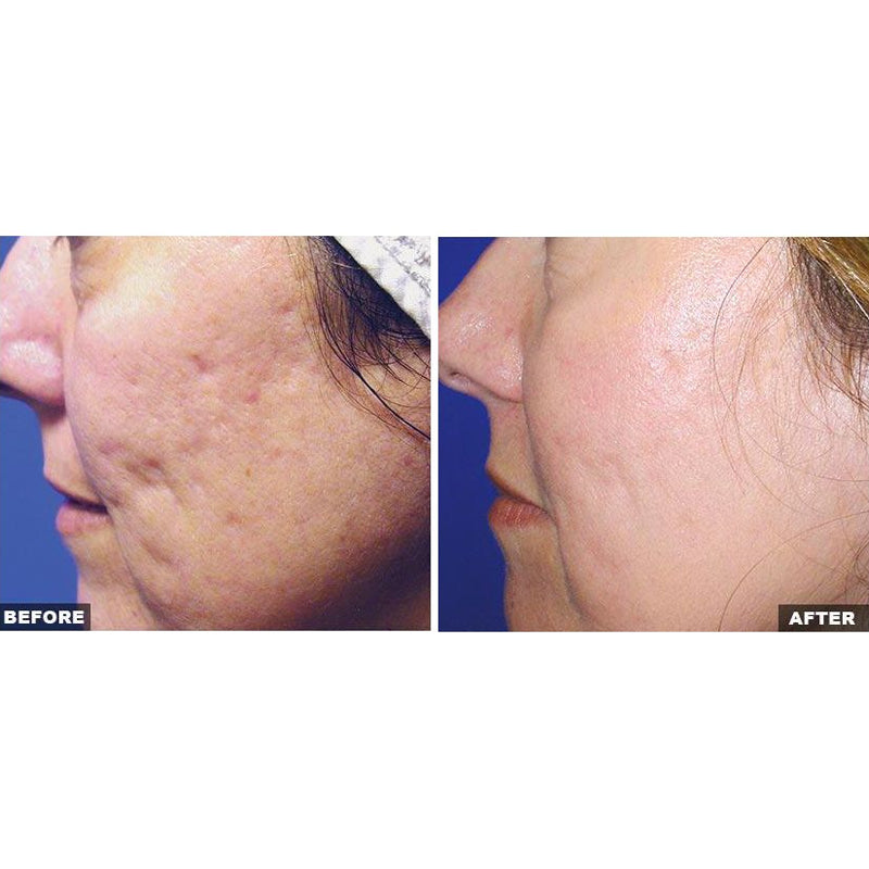 Fraxel Dual Laser Resurfacing