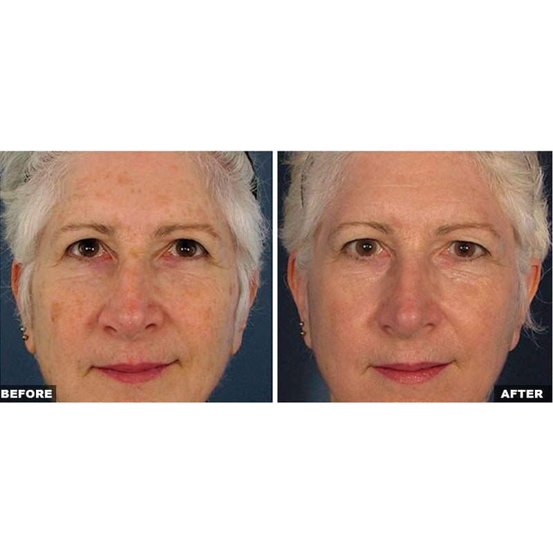 Fraxel Dual Laser Resurfacing