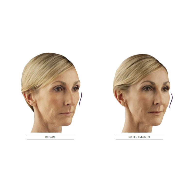 Juvéderm® Voluma XC