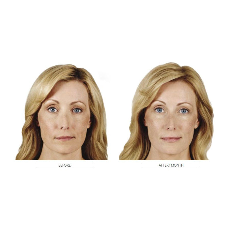 Juvéderm® Ultra XC