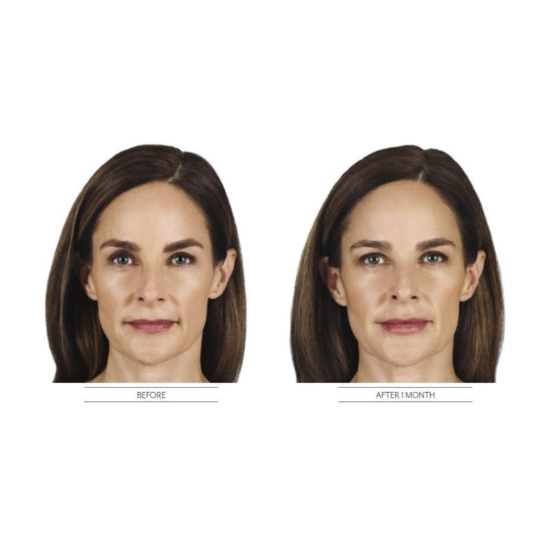 Juvéderm® Ultra XC