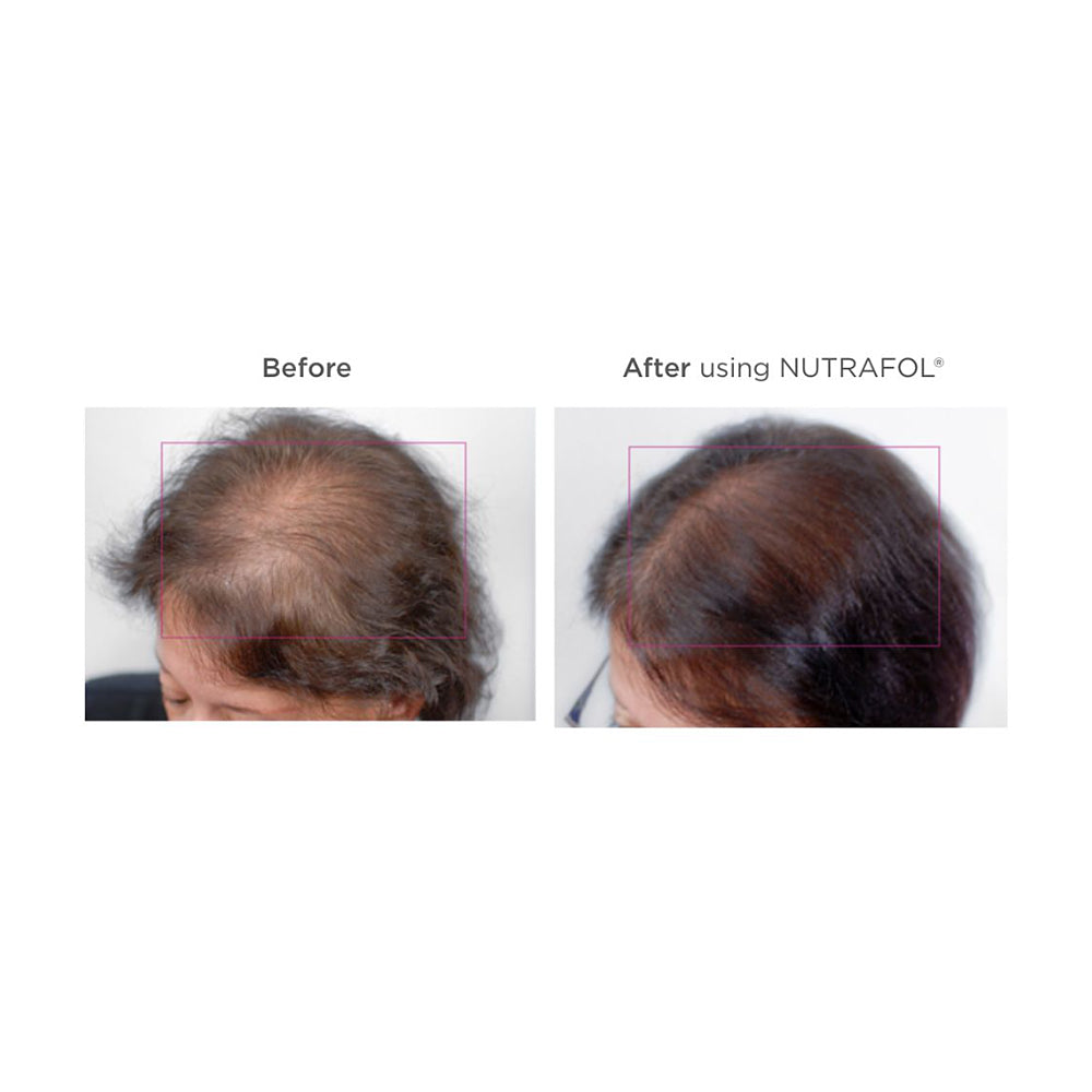Nutrafol® Women's Hair Growth 3-Month Supply