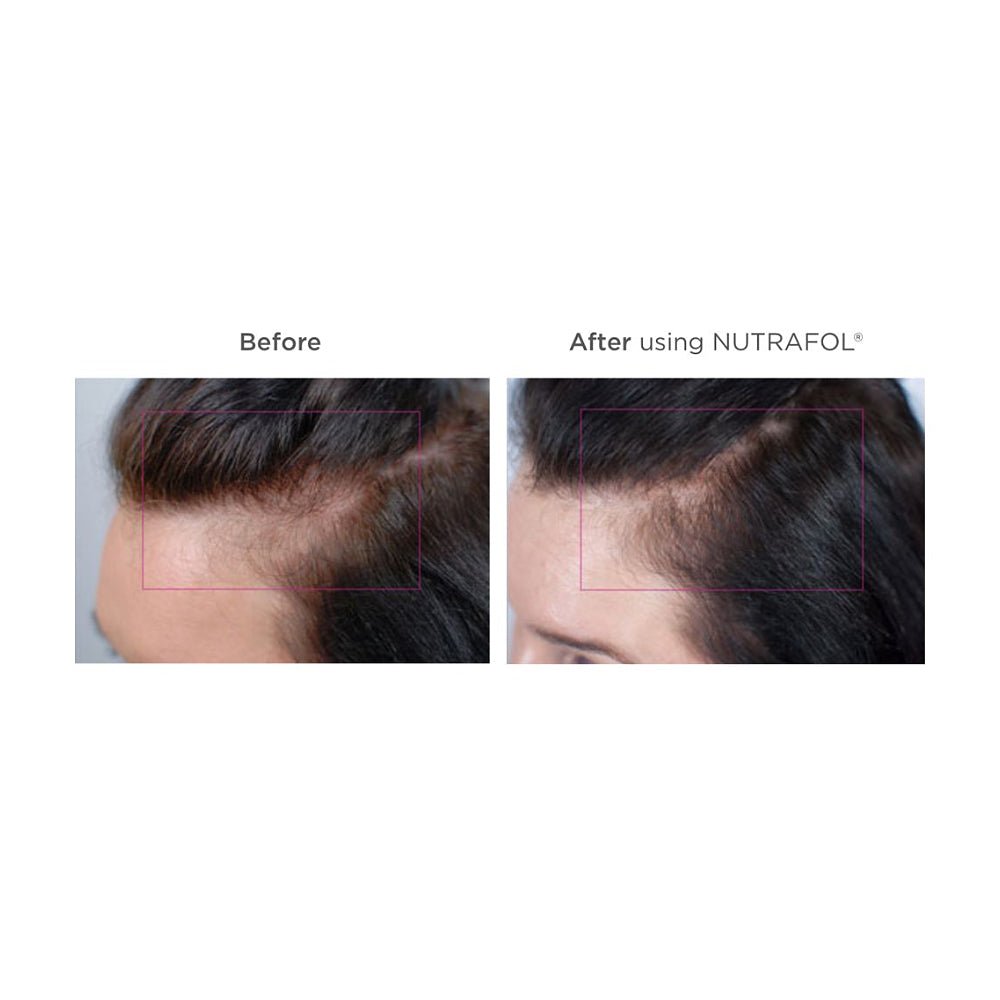 Nutrafol® Women's Hair Growth 3-Month Supply