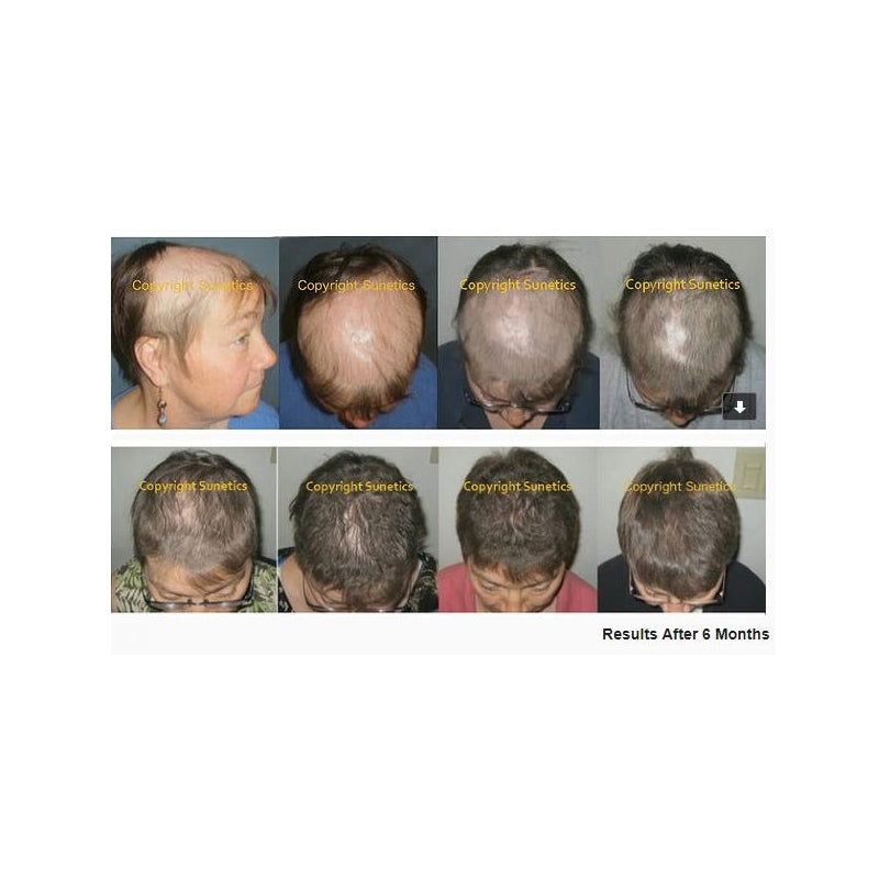 Sunetics Hair Growth Laser