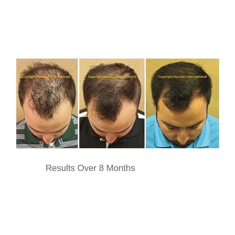 Sunetics Hair Growth Laser