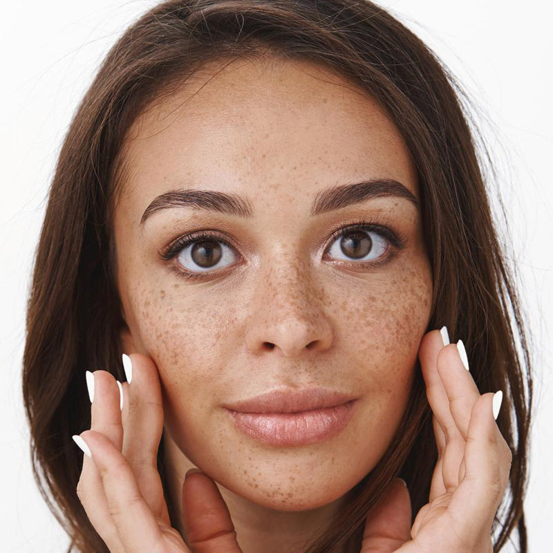 Melasma & Freckles