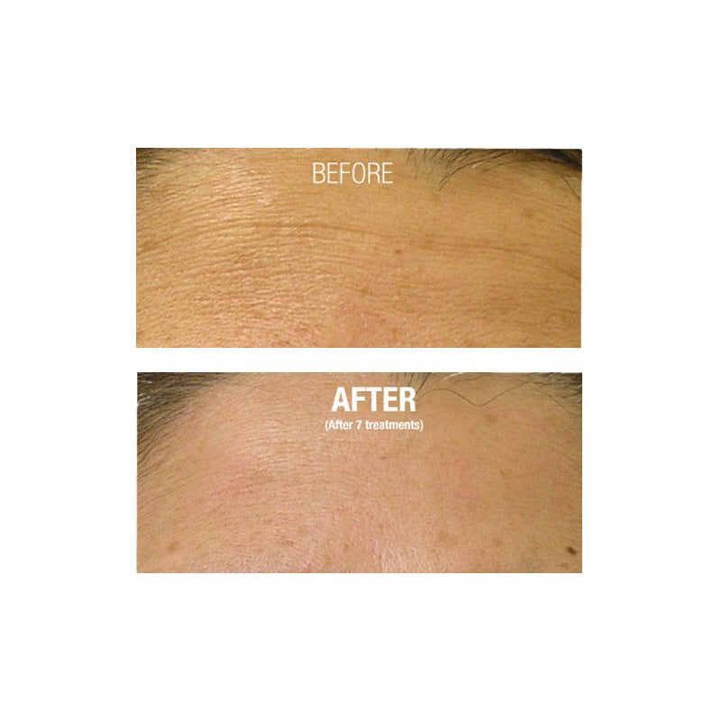 HydraFacial®