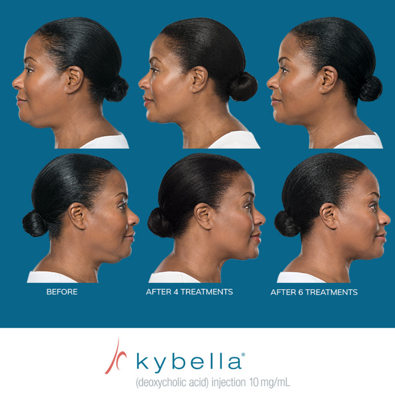 Kybella® Packages