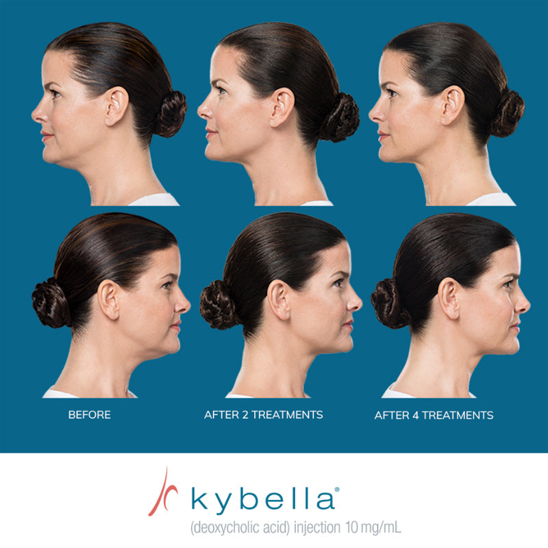 Kybella® Packages