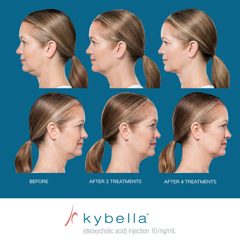 Kybella® Packages