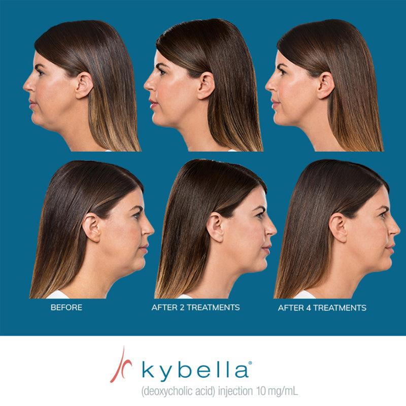 Kybella® Packages