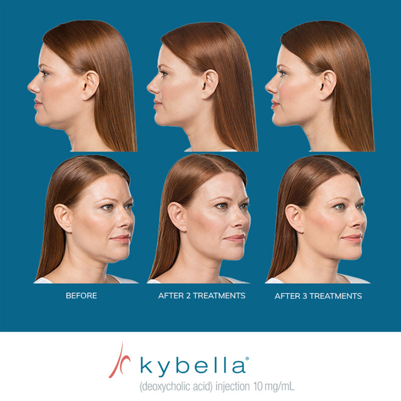 Kybella® Packages