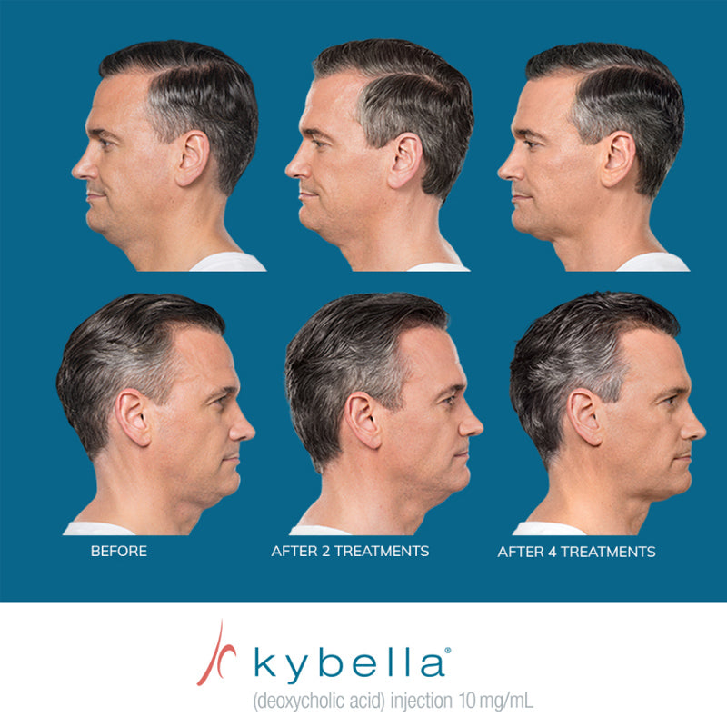 Kybella®