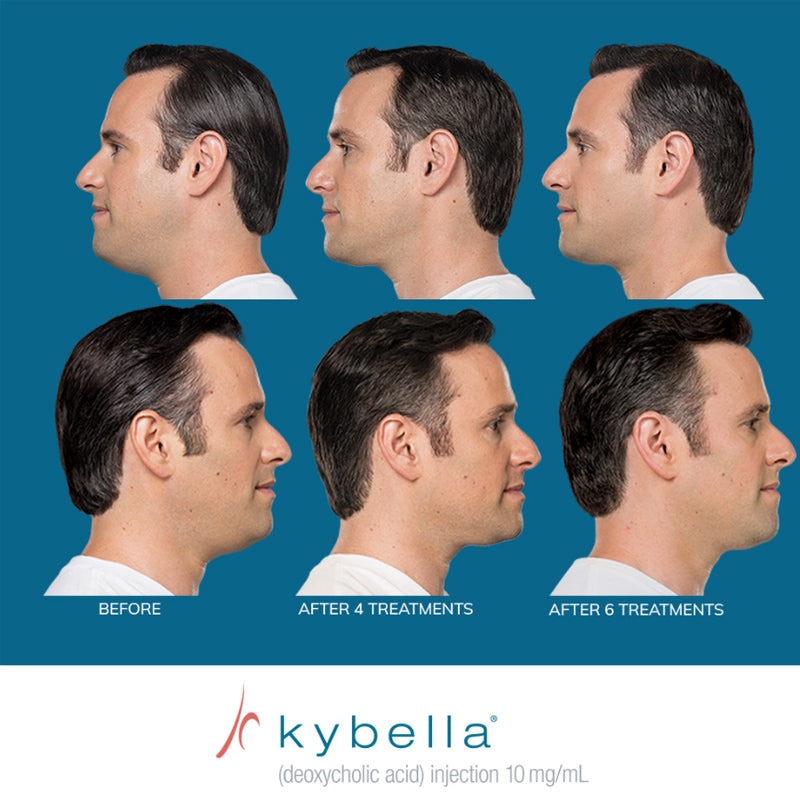 Kybella®