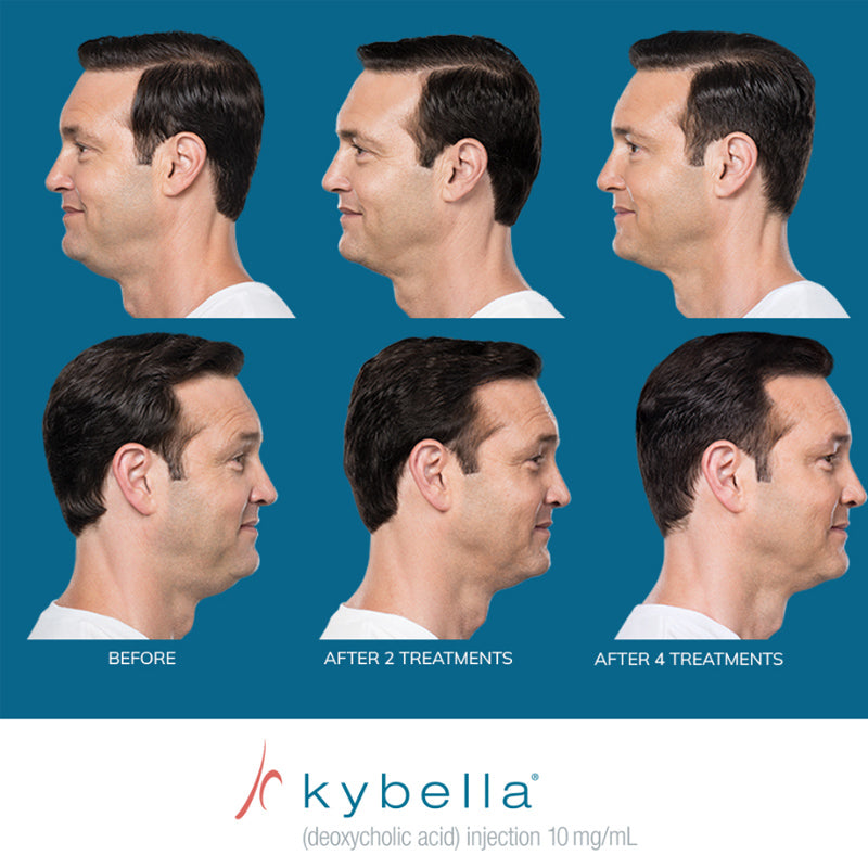 Kybella®