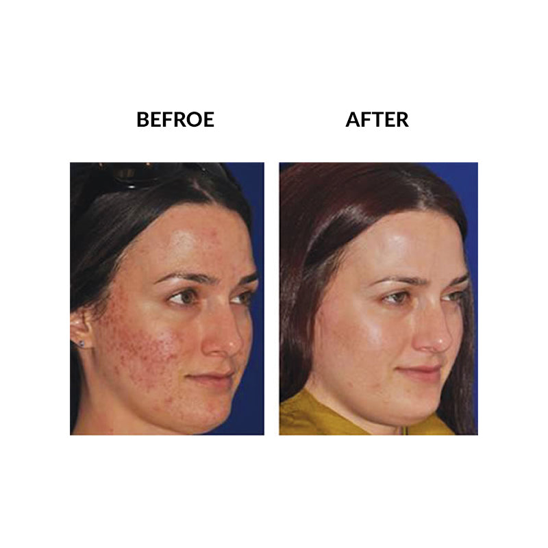 MicroPen™ Skin Rejuvenation Treatment