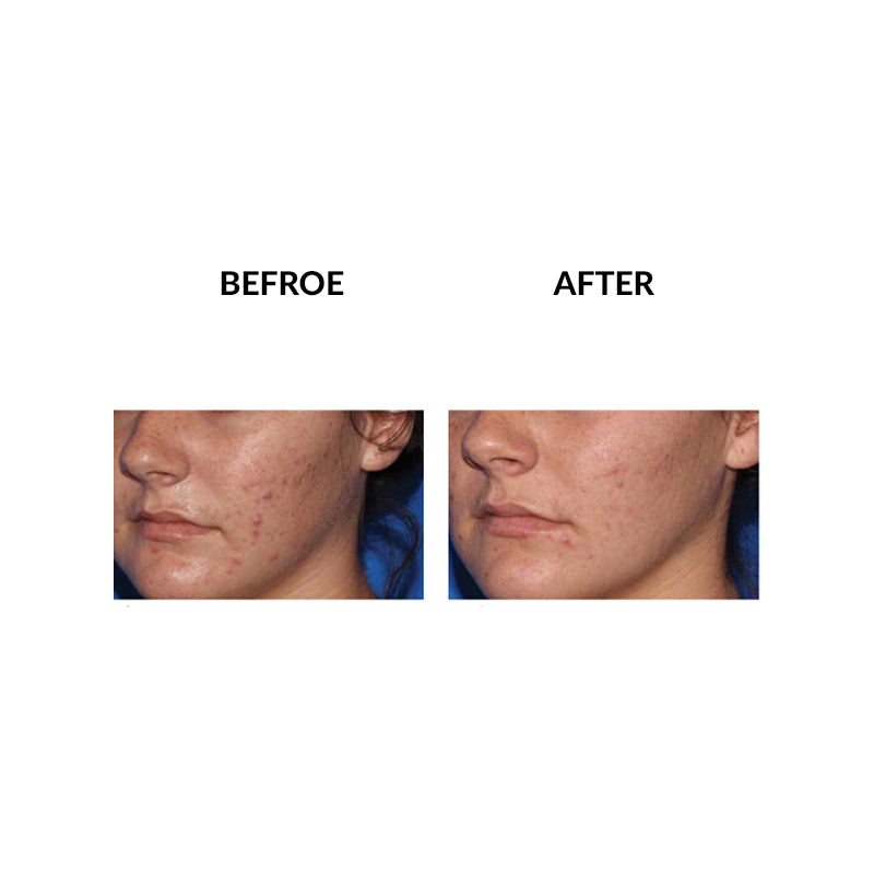 MicroPen™ Skin Rejuvenation Treatment