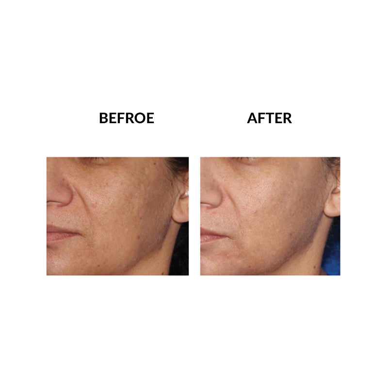 MicroPen™ Skin Rejuvenation Treatment