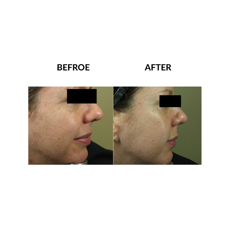 MicroPen™ Skin Rejuvenation Treatment