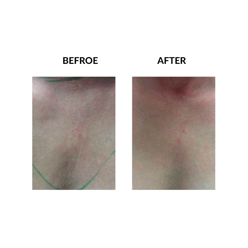 MicroPen™ Skin Rejuvenation Treatment