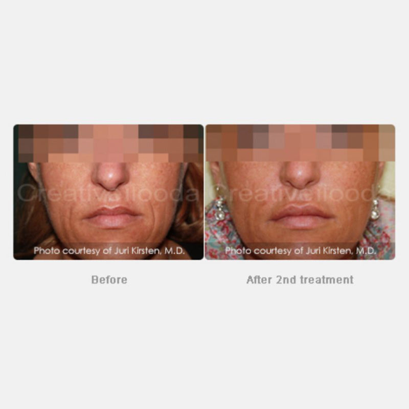 Secret Microneedling with RF Packages