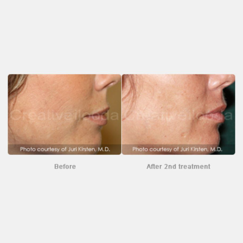 Secret Microneedling with RF Packages